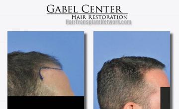 Hair transplantation surgery before and after photos