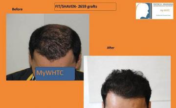 Hair restoration procedure before and after results