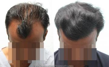 Hair transplantation surgery before and after photos