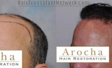 Hair transplantation surgery before and after pictures