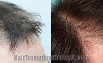 Right view before and after hair restoration procedure