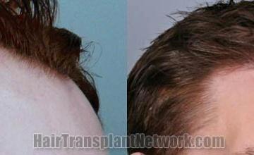 Hair restoration procedure before and after results