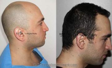 Hair transplantation surgery before and after photos