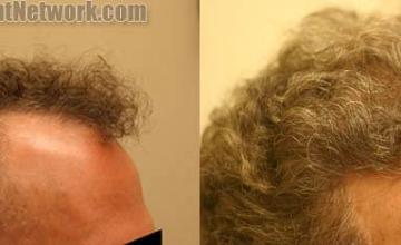 Hair restoration procedure before and after results