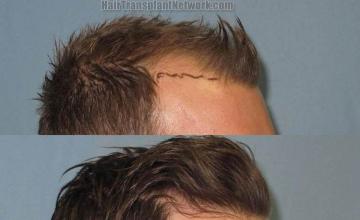 Hair restoration procedure before and after pictures