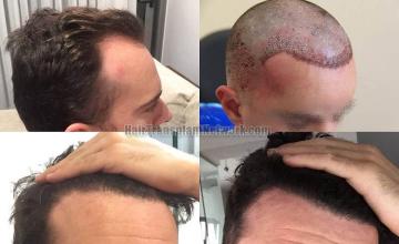 Hair restoration procedure before and after result images