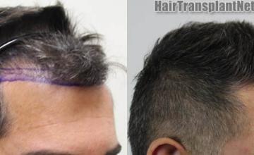 Hair restoration procedure after result images