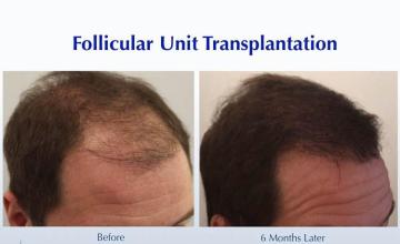 Hair restoration procedure after result images