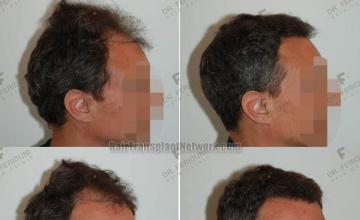 Hair restoration procedure before and after results