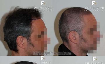 Hair restoration procedure before and after results