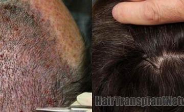 Scar / Intraoperative hair restoration photos