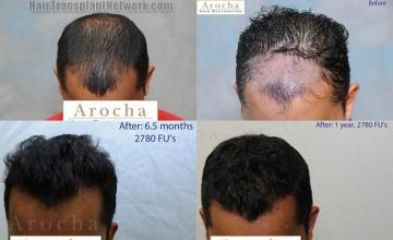 Hair transplantation surgery before and after photos