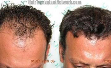 Hair transplantation surgery before and after images