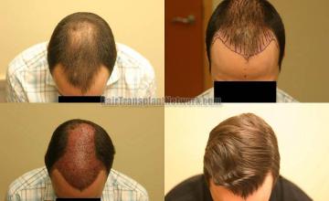 Hair restoration procedure before and after results