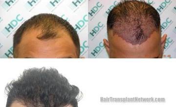 Hair transplantation surgery before and after pictures