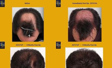 Hair transplantation surgery before and after photos