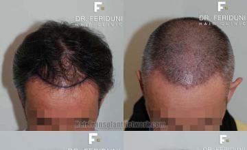 Top view before and after hair restoration results