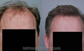 Hair restoration procedure before and after results