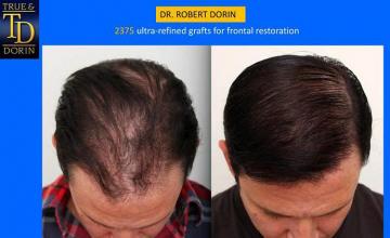 Hair transplantation surgery before and after photos