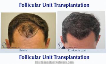 Hair transplantation surgery before and after images