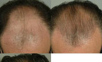 Top view - Before and after surgical hair replacement