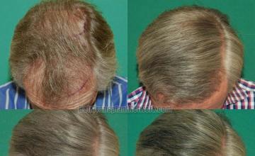 Hair restoration procedure before and after results