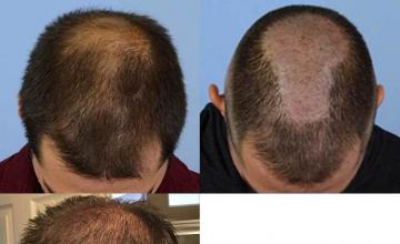 Hair restoration procedure before and after pictures