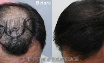 Hair transplantation surgery before and after photos