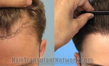 Hair restoration procedure before and after results