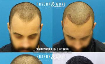 Hair transplantation surgery before and after images