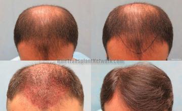 Hair restoration procedure before and after photo results