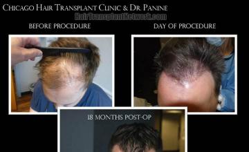 Before and after hair restoration procedure images