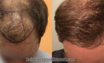 Hair transplantation surgery before and after images