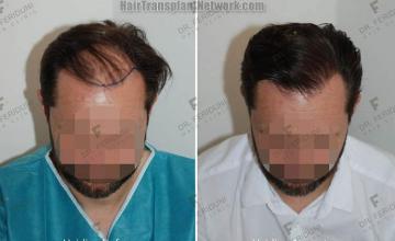 Hair transplantation surgery before and after images