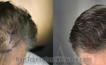 Hair transplantation surgery before and after images