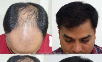 Hair transplantation surgery before and after images