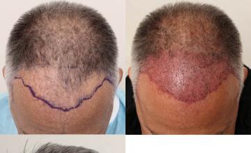 Hair transplantation surgery before and after images