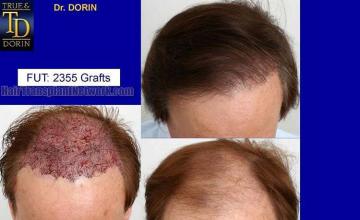 Hair transplant procedure before and postoperative images