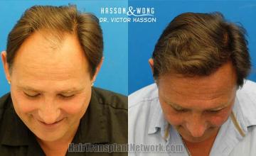 Hair restoration surgery before and after images