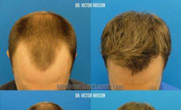 Top view before and after hair restoration results