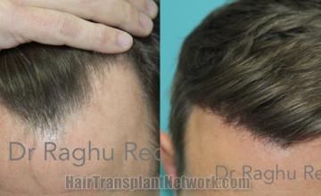 Top view - Before and after hair restoration results