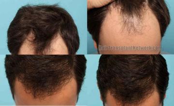 Top view before and after hair restoration results