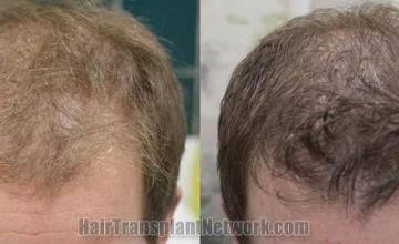 Hair restoration procedure before and after results