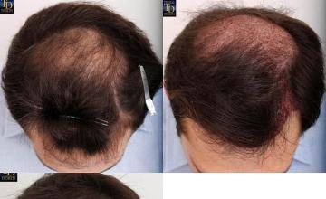 Hair restoration procedure before and after results