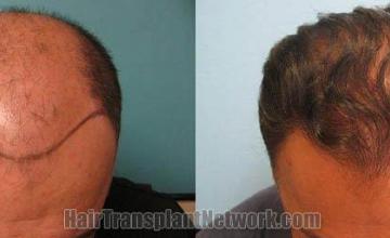 Hair transplantation surgery before and after images