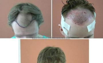 Top view before and after hair restoration results