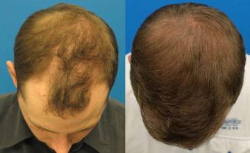 Top view - Before and after surgical hair replacement