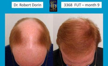 Hair restoration procedure before and after results