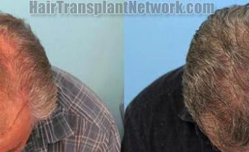 Hair transplantation surgery before and after images