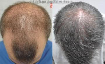 Top view before and after hair restoration results